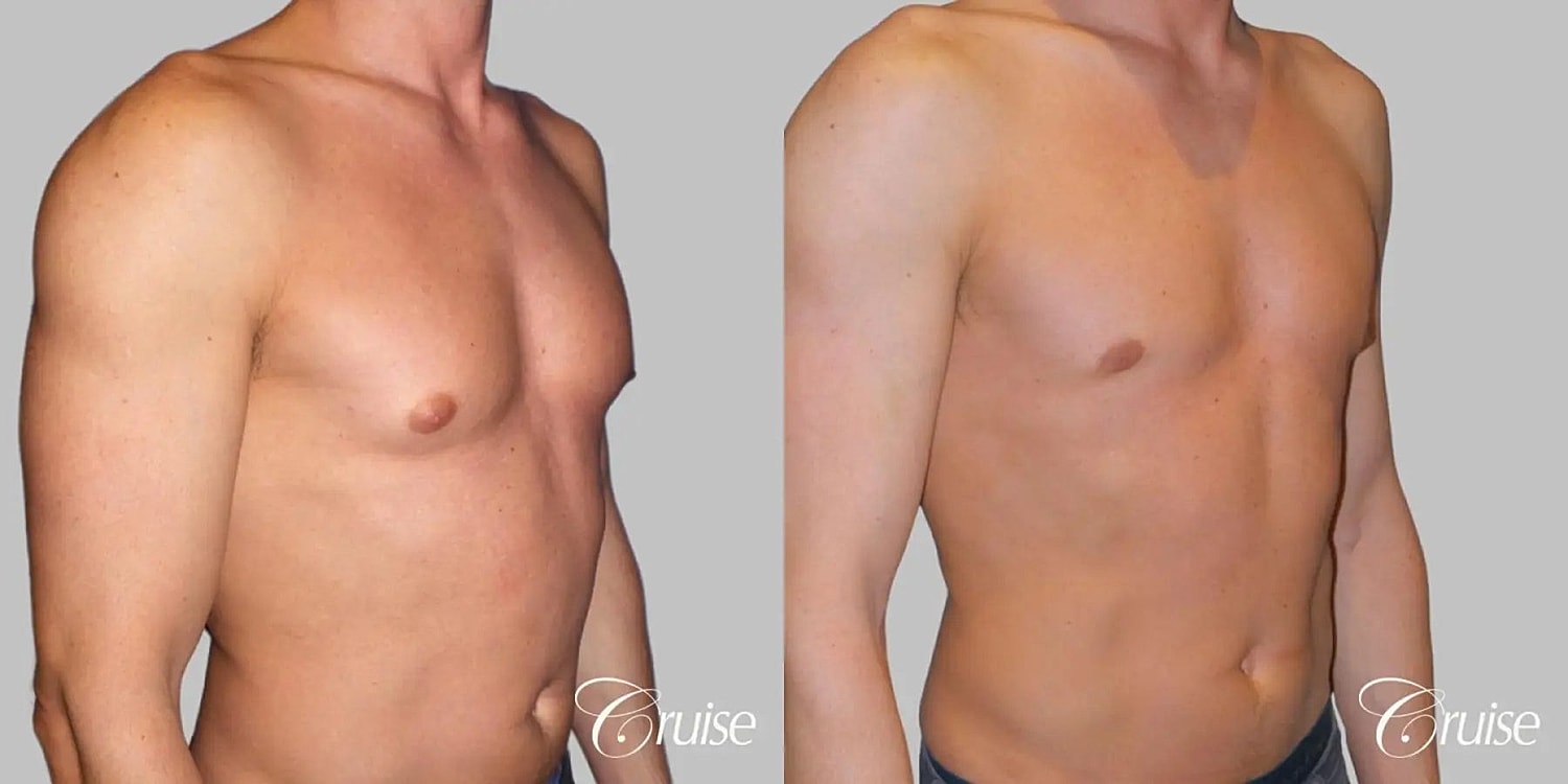 Gynecomastia Before & After