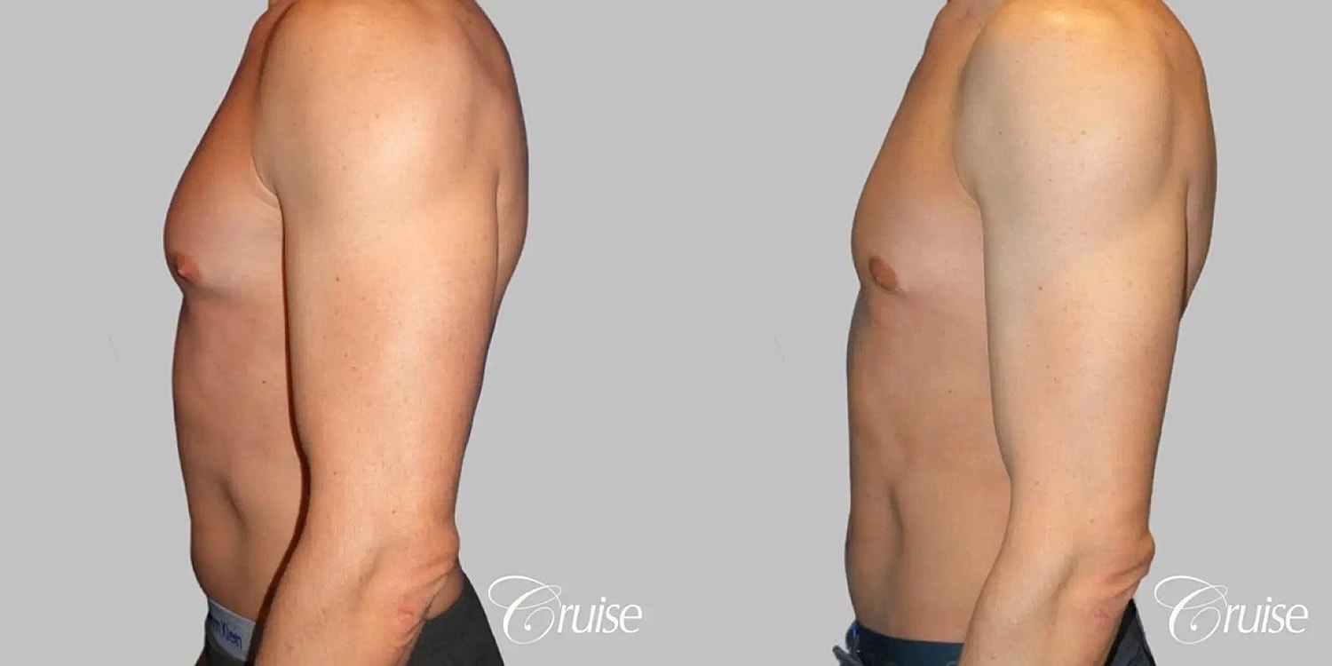 Gynecomastia Before & After
