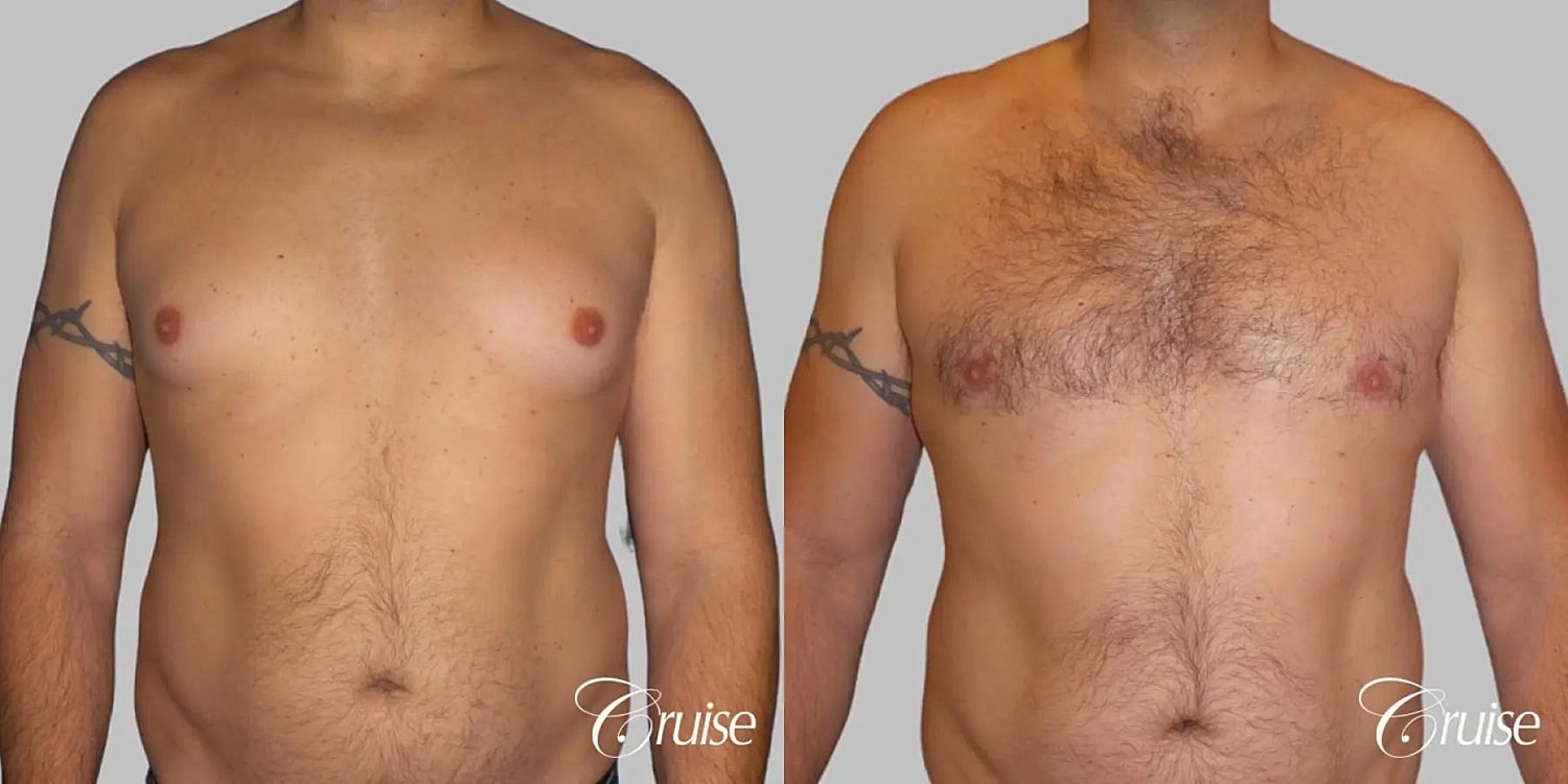 Gynecomastia Before & After