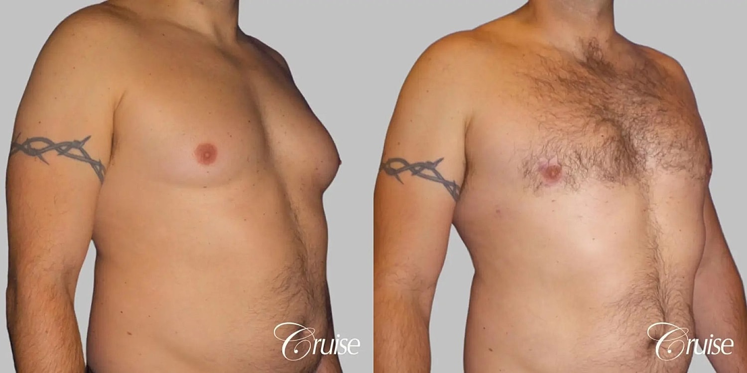 Gynecomastia Before & After