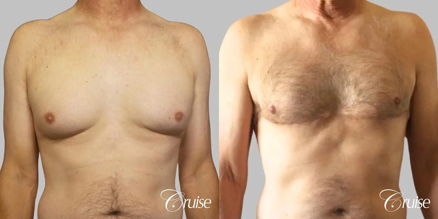 Gynecomastia Before & After