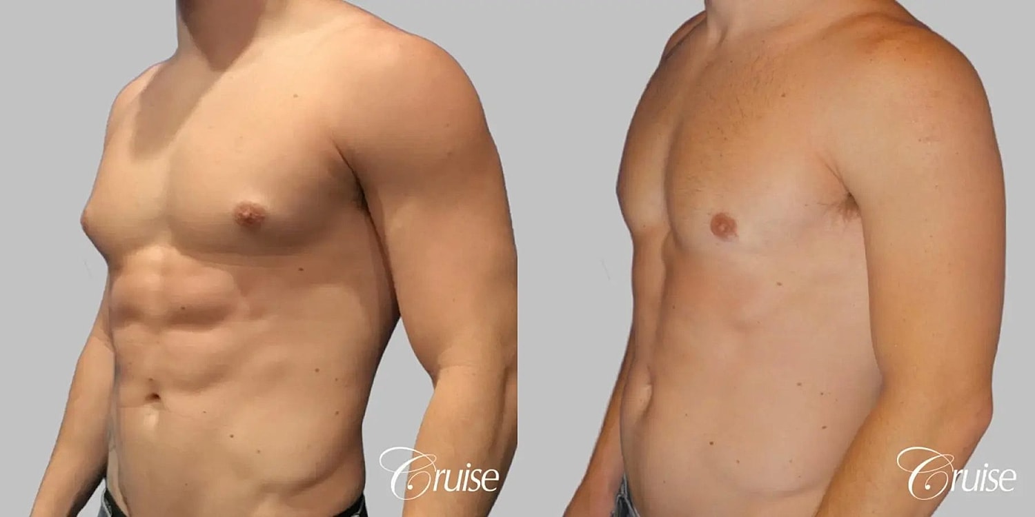 Gynecomastia Before & After
