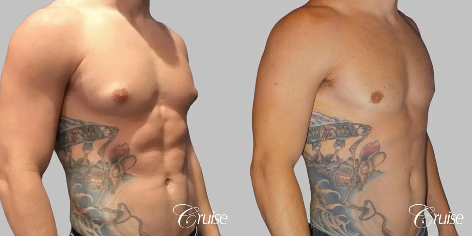 Gynecomastia Before & After