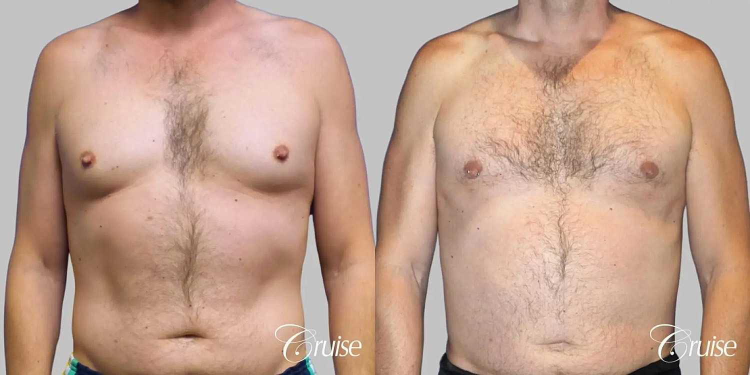Gynecomastia Before & After