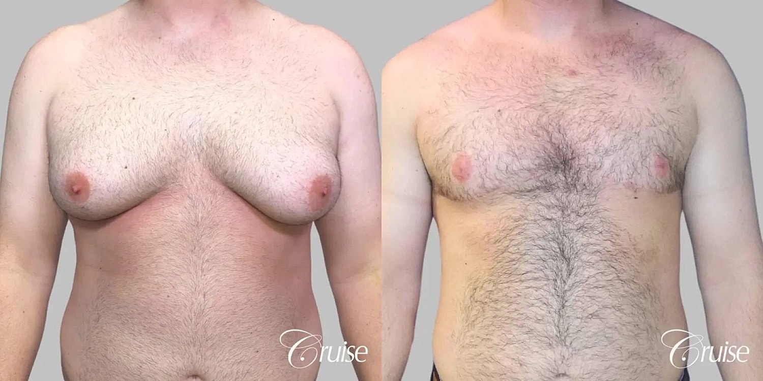 Gynecomastia Before & After