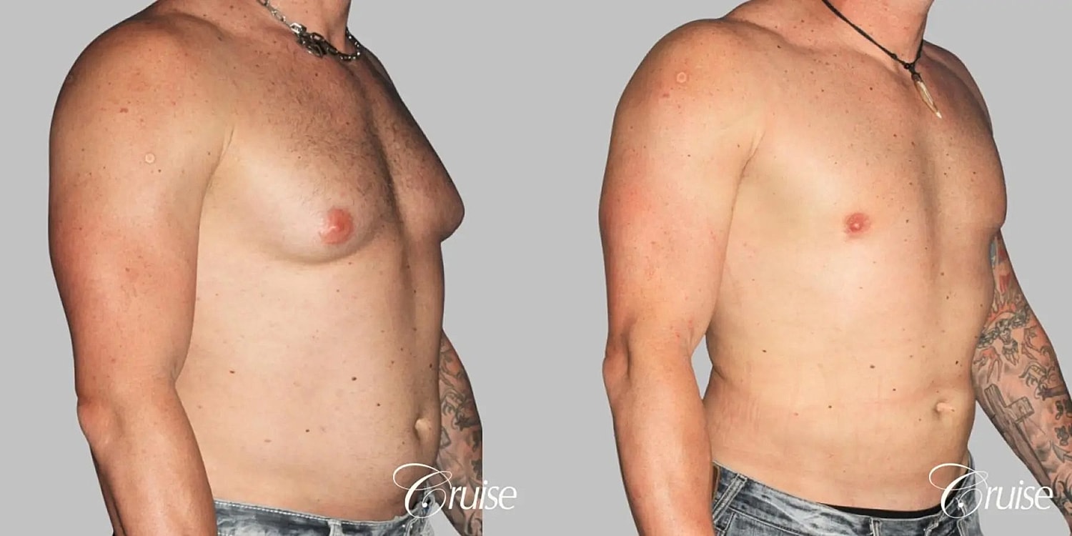 Gynecomastia Before & After