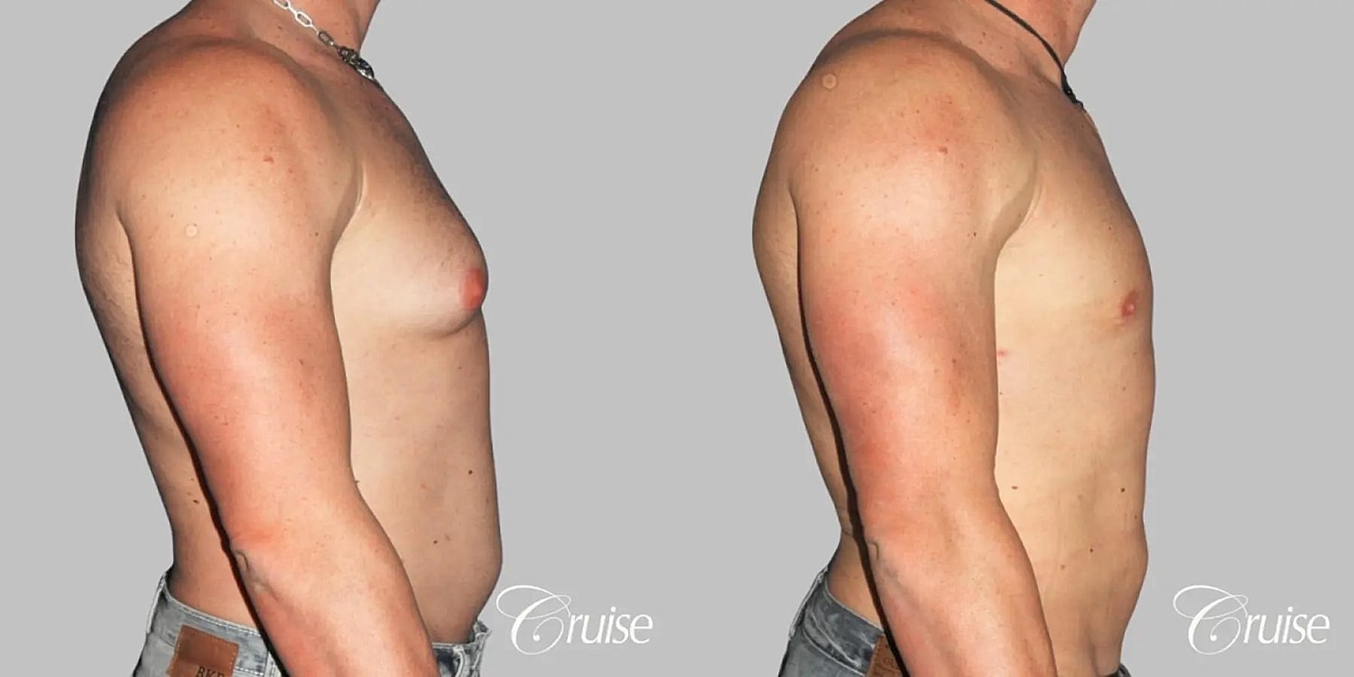 Gynecomastia Before & After