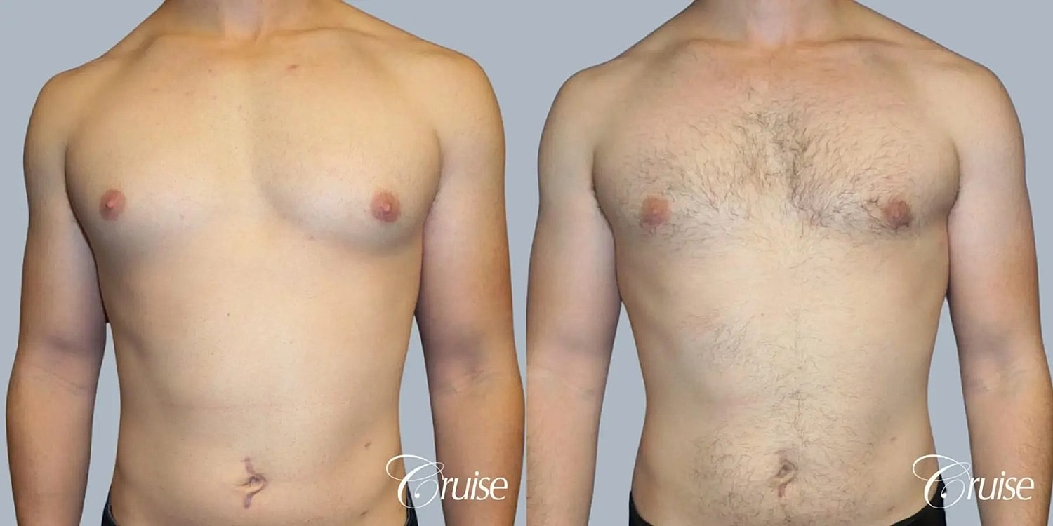 Gynecomastia Before & After