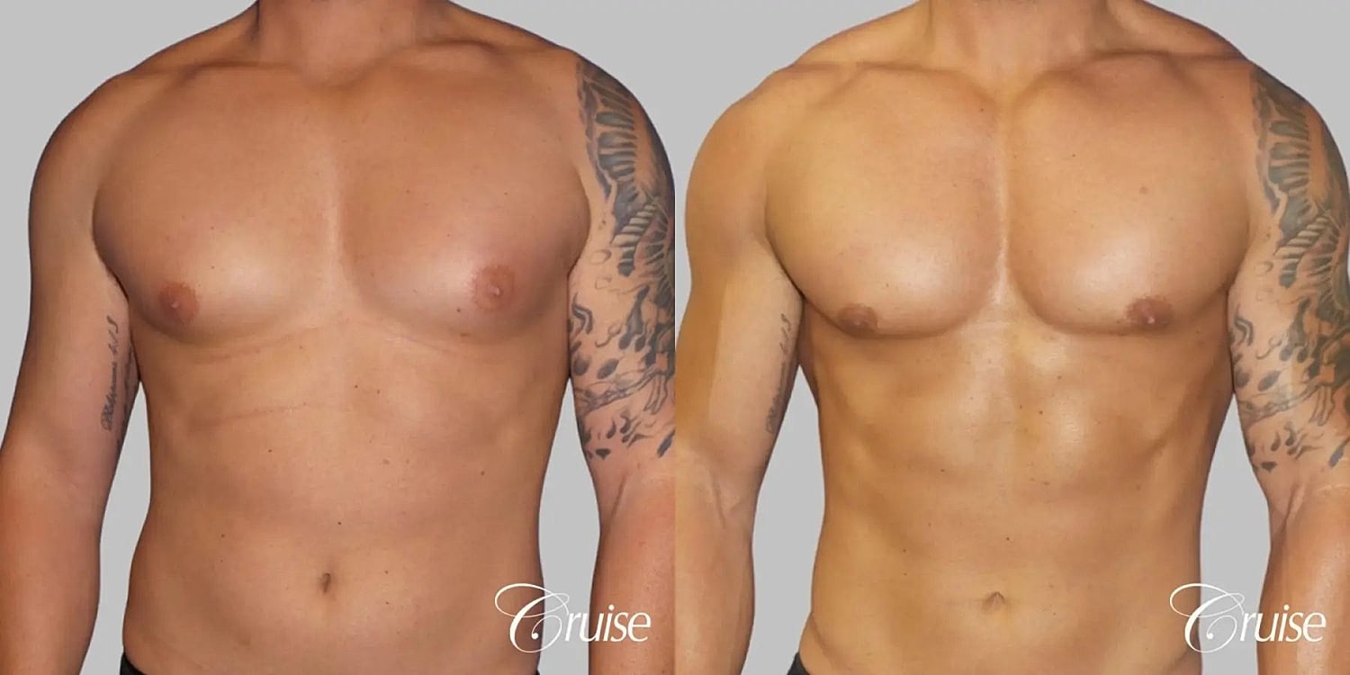 Gynecomastia Before & After