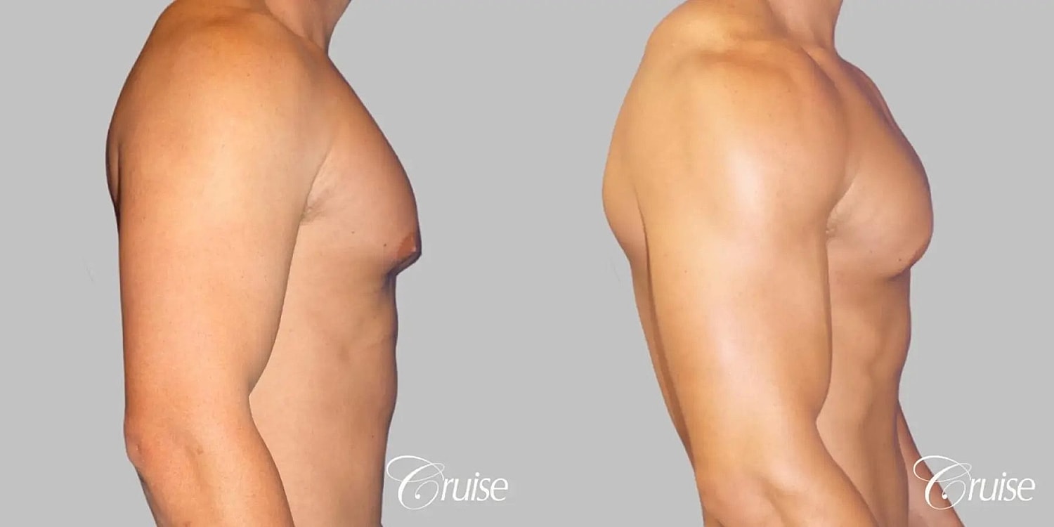 Gynecomastia Before & After