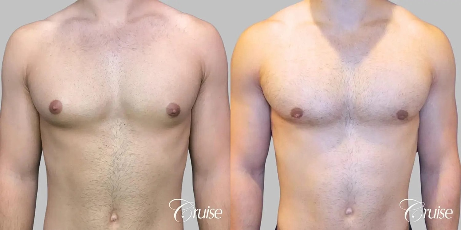 Gynecomastia Before & After