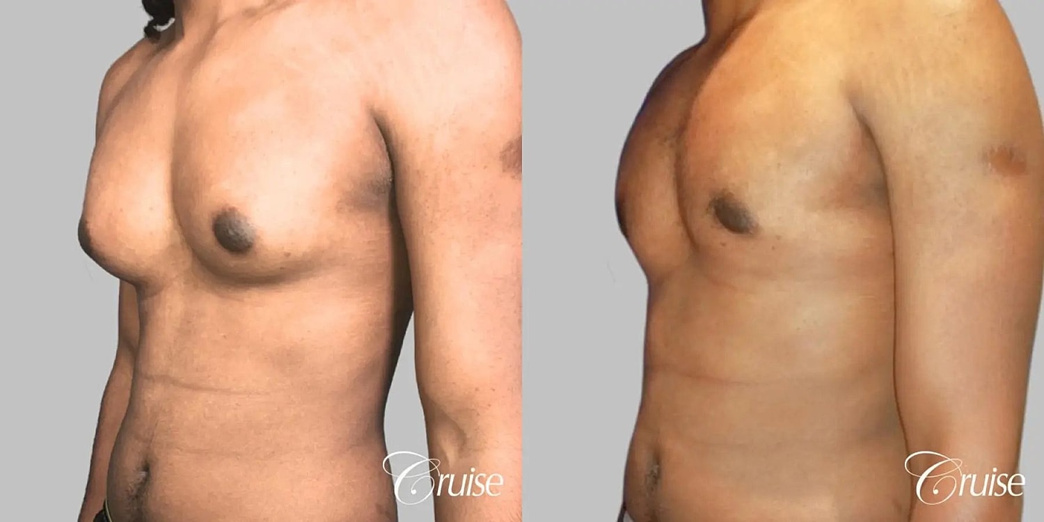 Gynecomastia Before & After