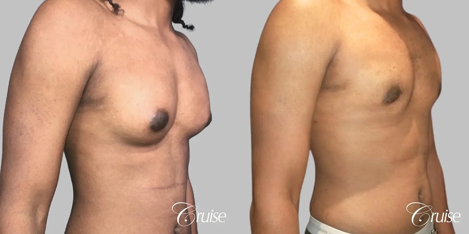 Gynecomastia Before & After