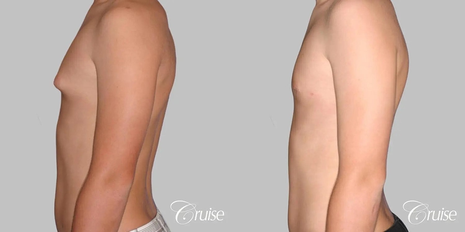 Gynecomastia Before & After