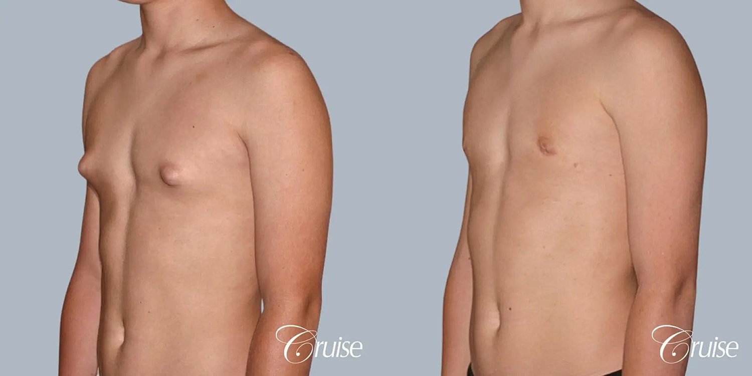Gynecomastia Before & After