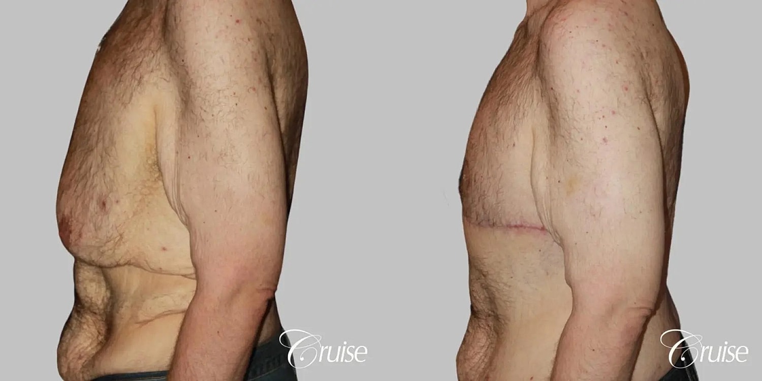 Gynecomastia Before & After