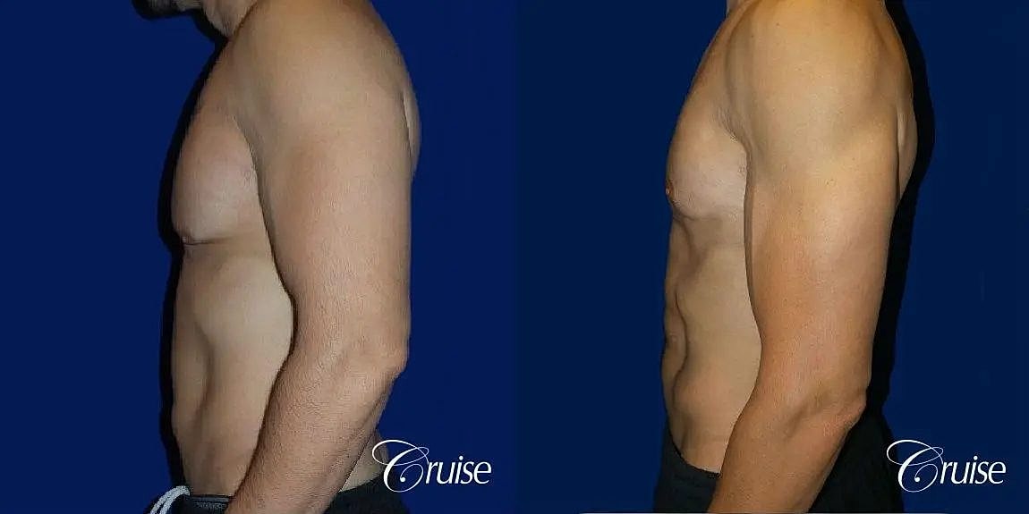 Gynecomastia Before & After