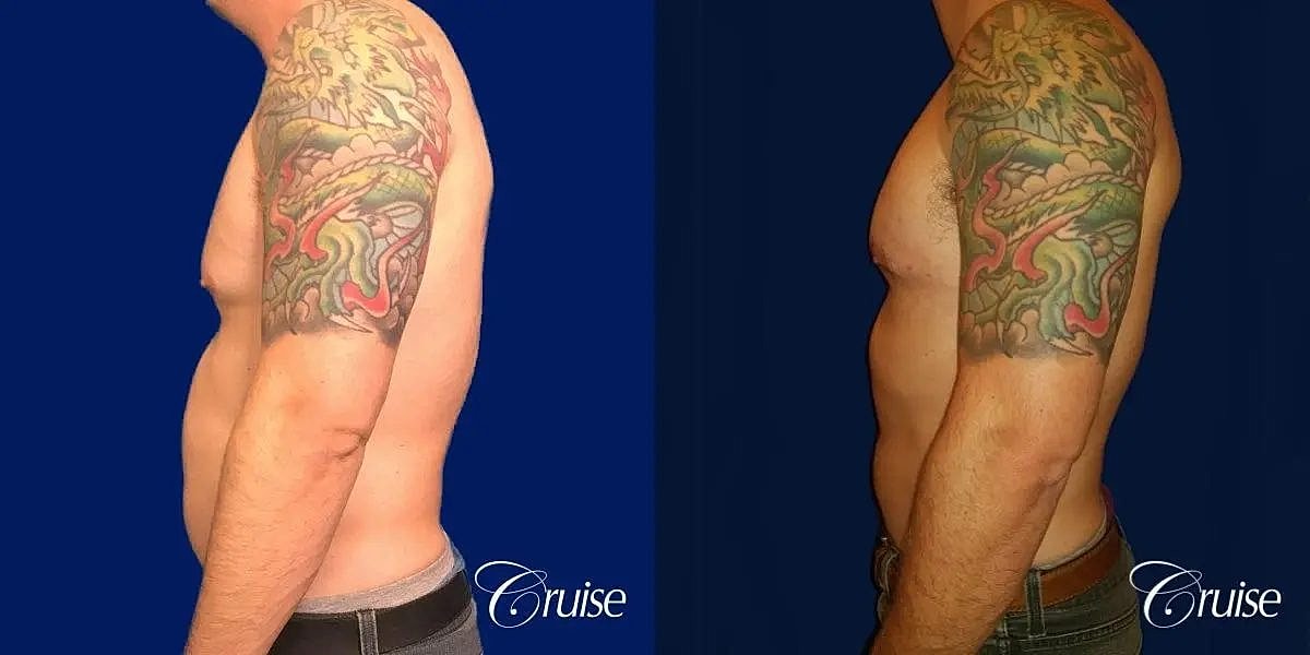 Gynecomastia Before & After