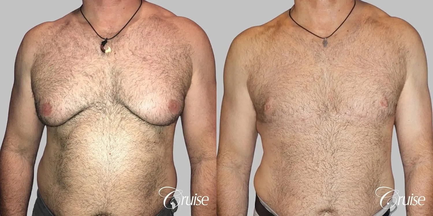 Gynecomastia Before & After