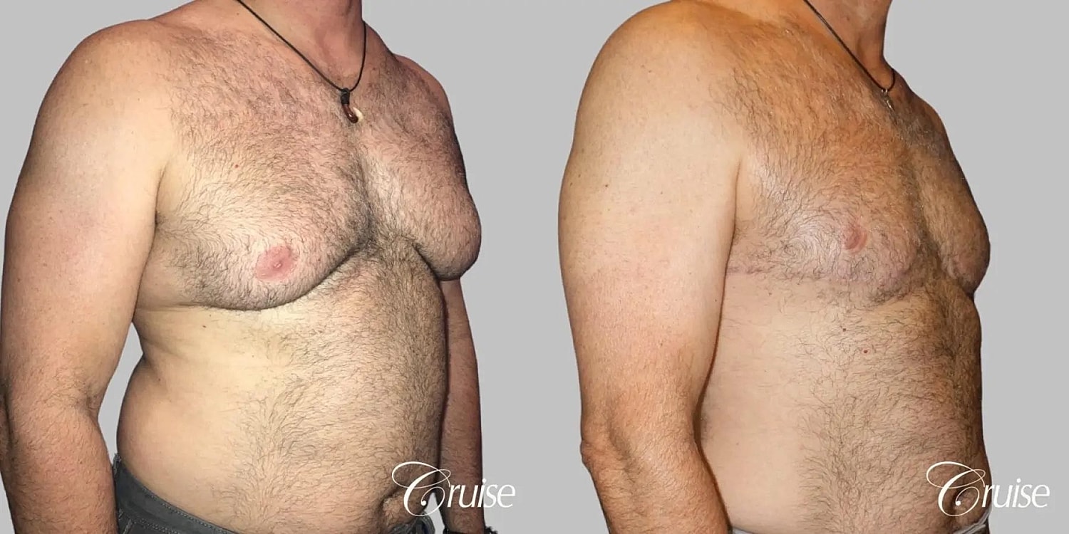 Gynecomastia Before & After