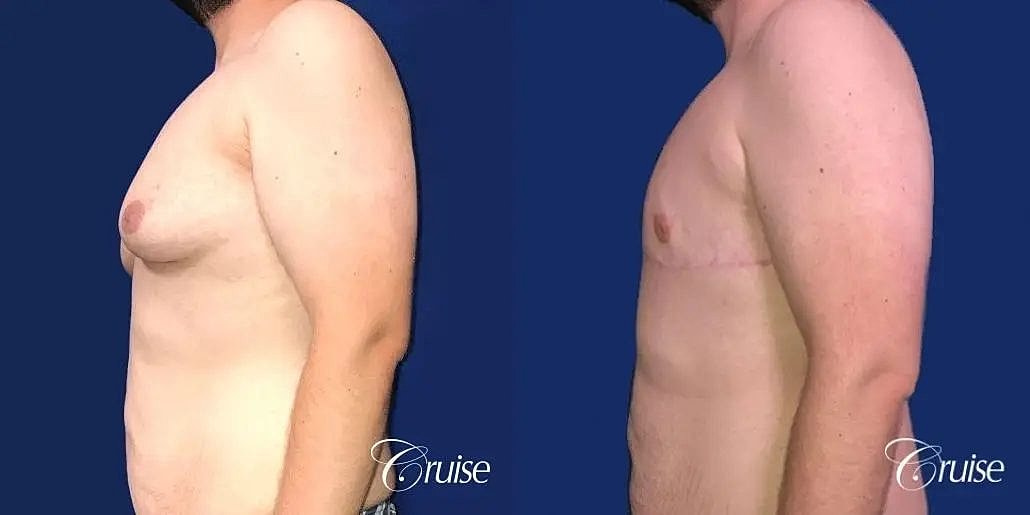 Gynecomastia Before & After