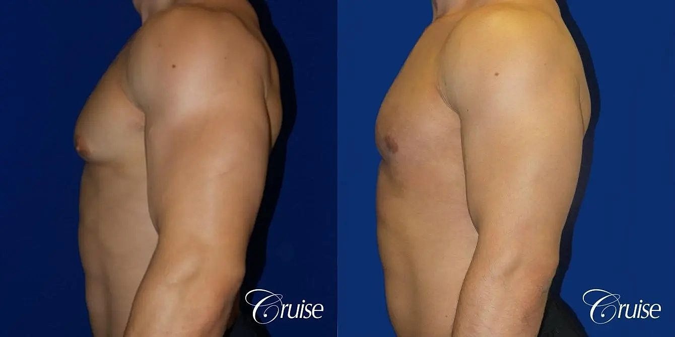 Gynecomastia Before & After