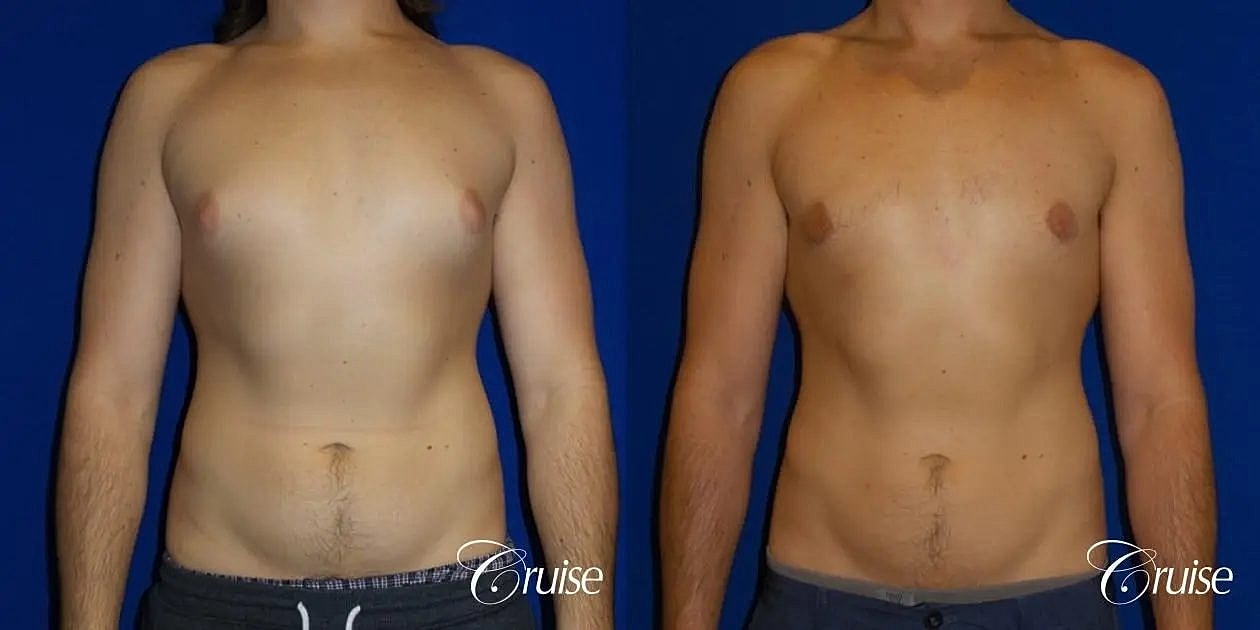 Gynecomastia Before & After