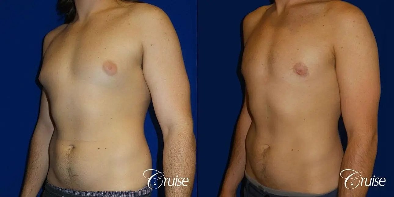 Gynecomastia Before & After