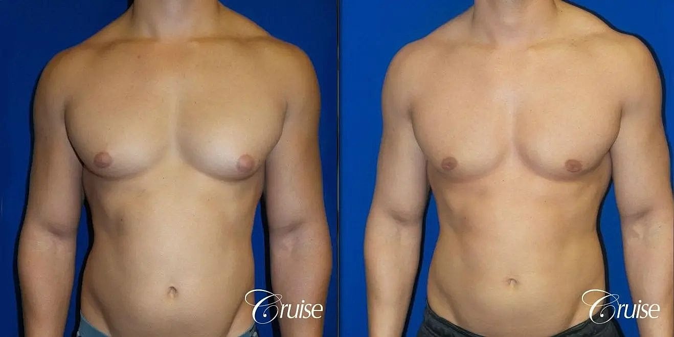 Gynecomastia Before & After