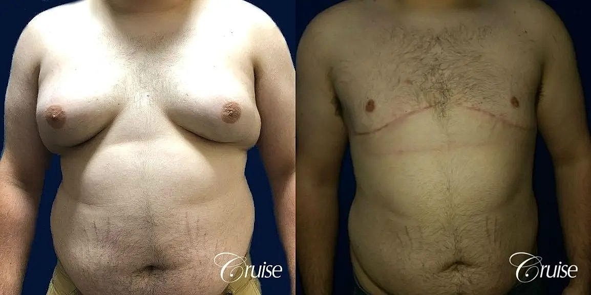 Gynecomastia Before & After