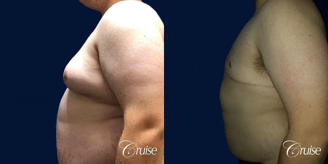 Gynecomastia Before & After