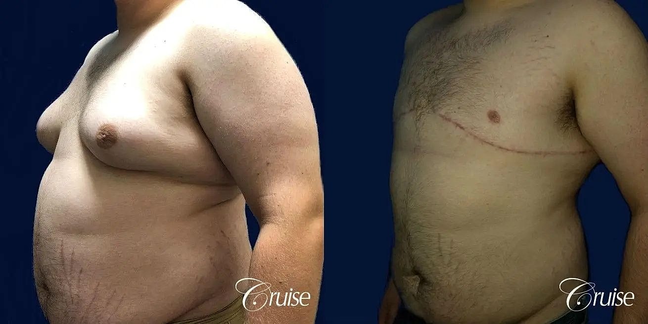 Gynecomastia Before & After