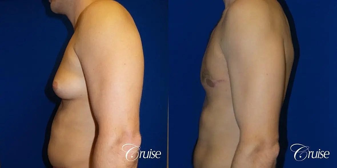 Gynecomastia Before & After