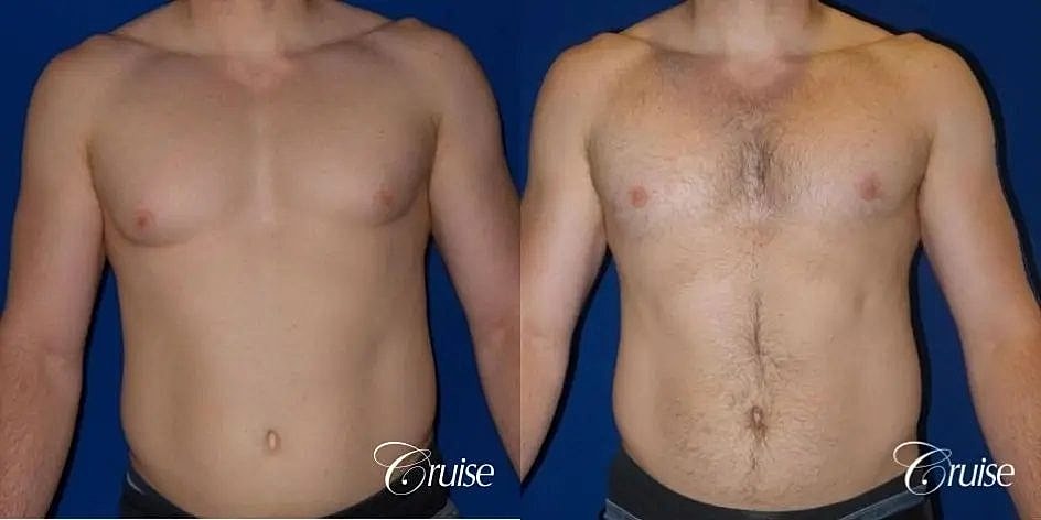 Gynecomastia Before & After
