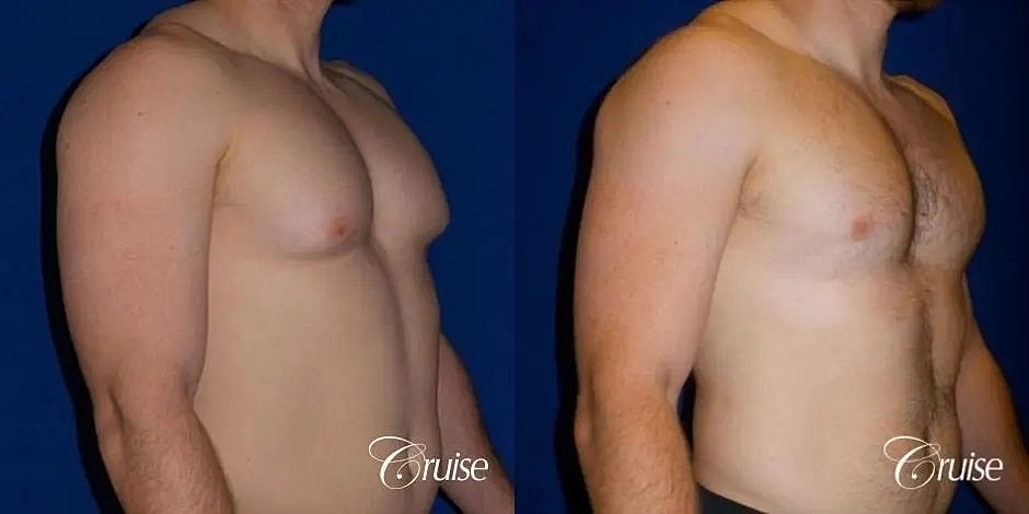 Gynecomastia Before & After
