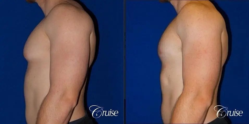 Gynecomastia Before & After