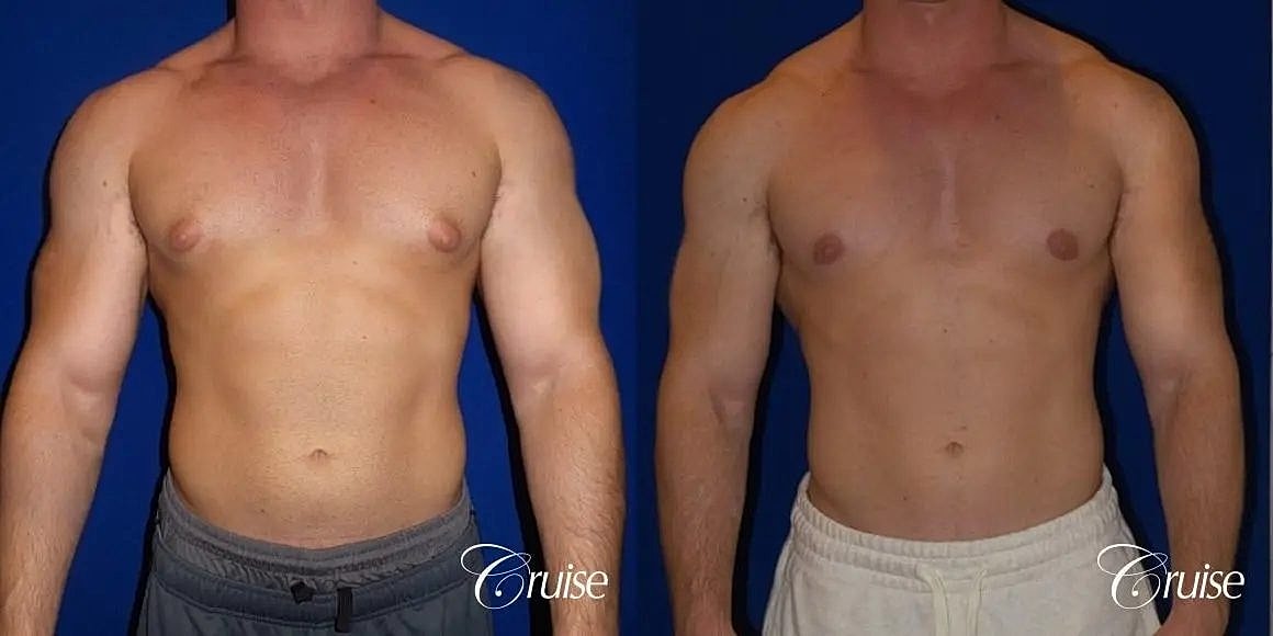 Gynecomastia Before & After