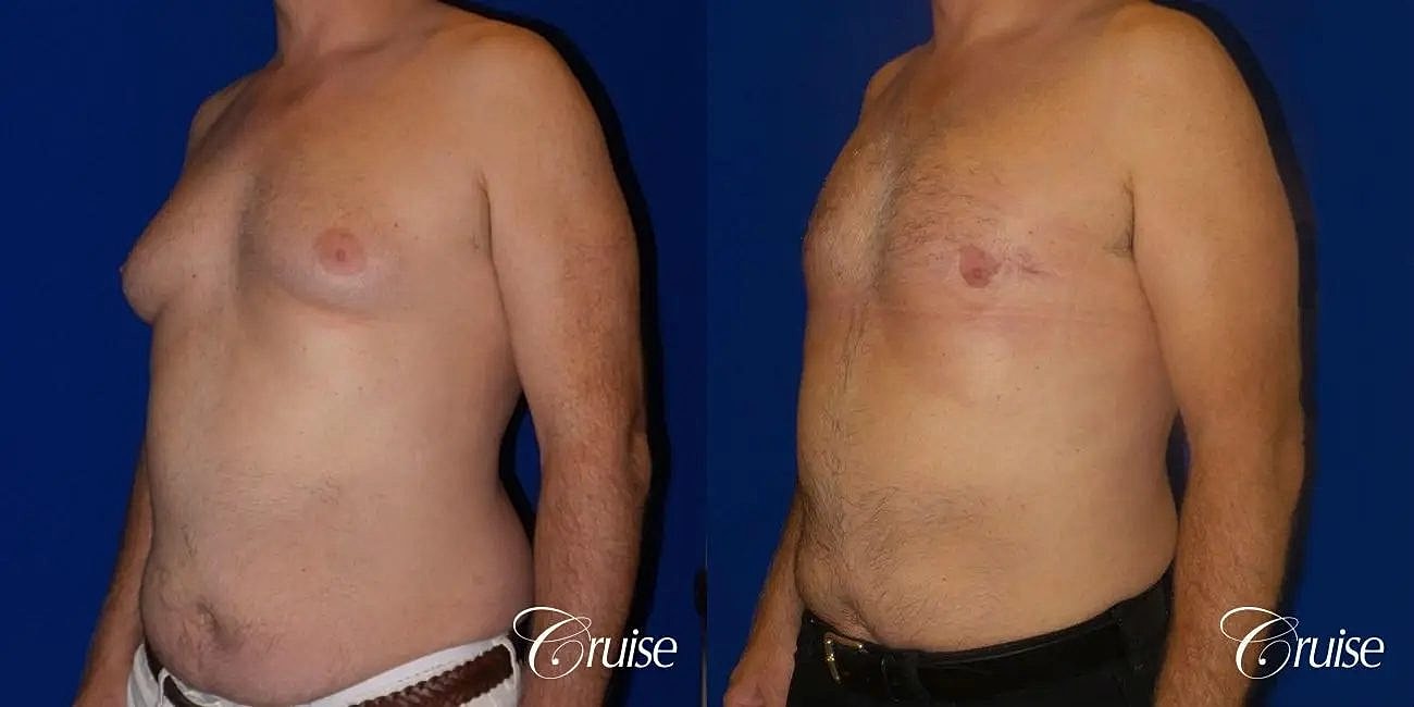 Gynecomastia Before & After