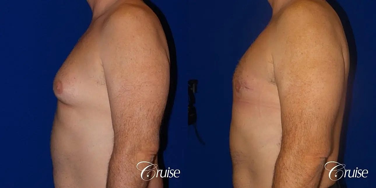 Gynecomastia Before & After