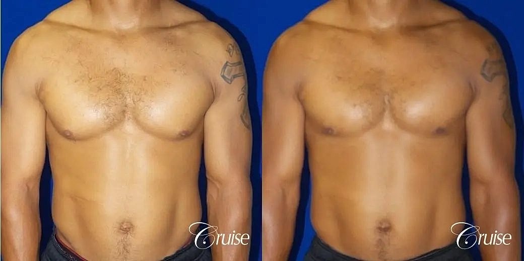 Gynecomastia Before & After