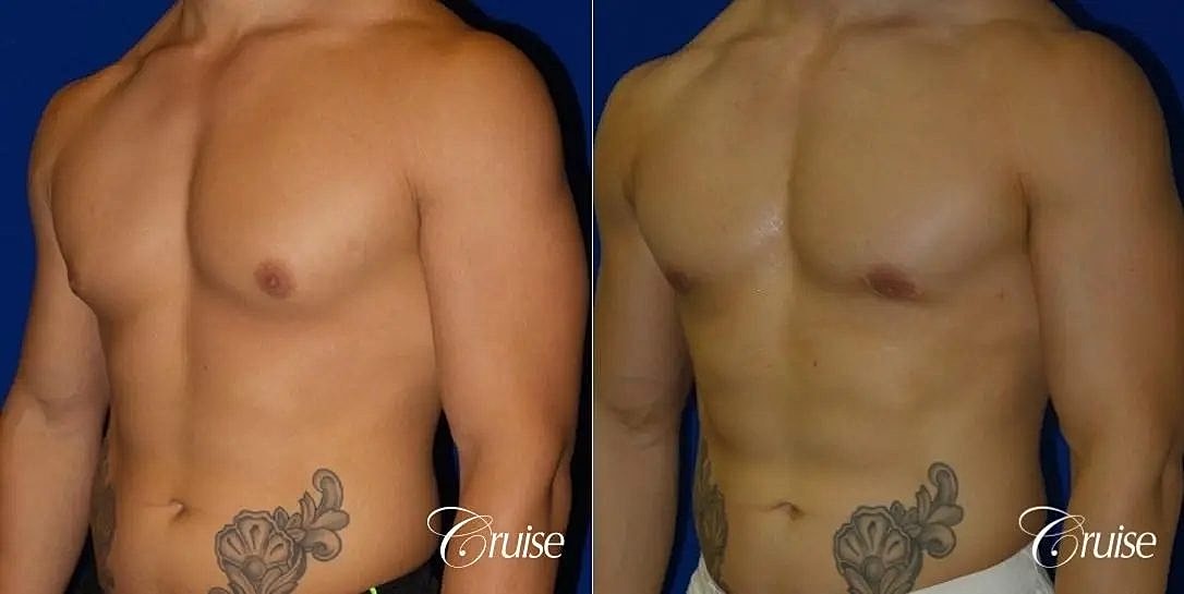 Gynecomastia Before & After