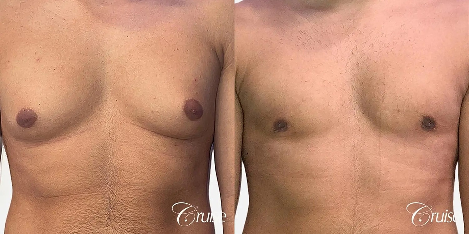 Gynecomastia Before & After