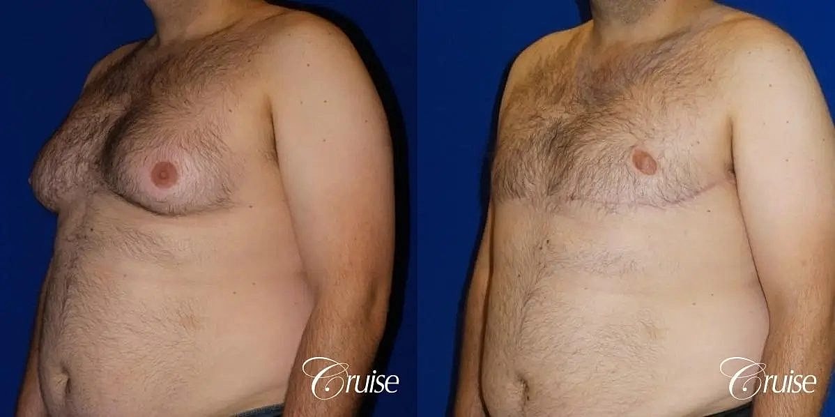 Gynecomastia Before & After