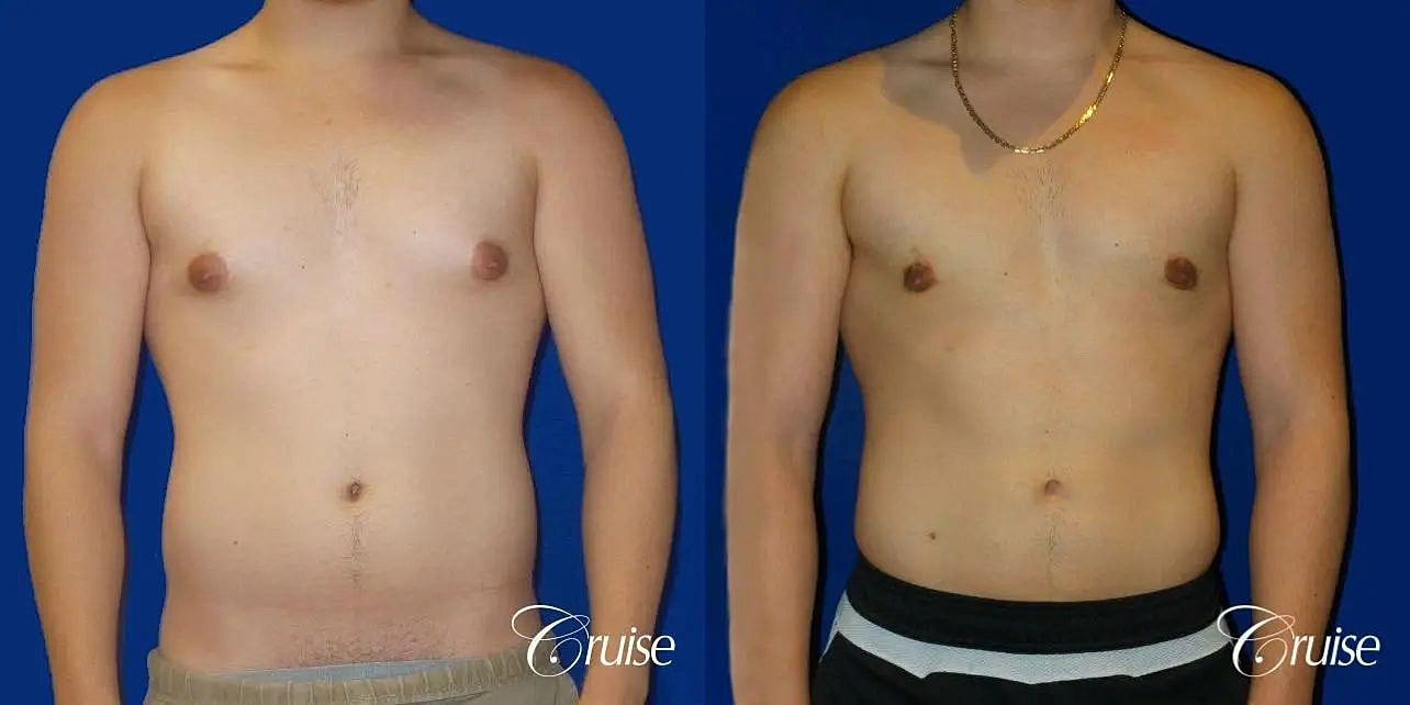 Gynecomastia Before & After