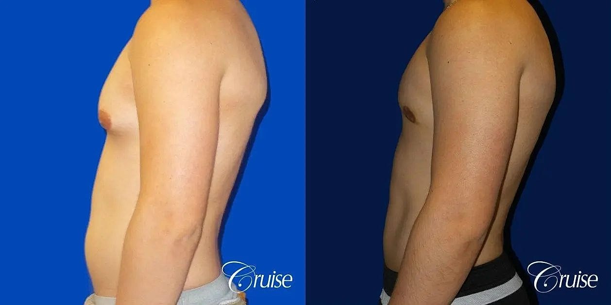 Gynecomastia Before & After