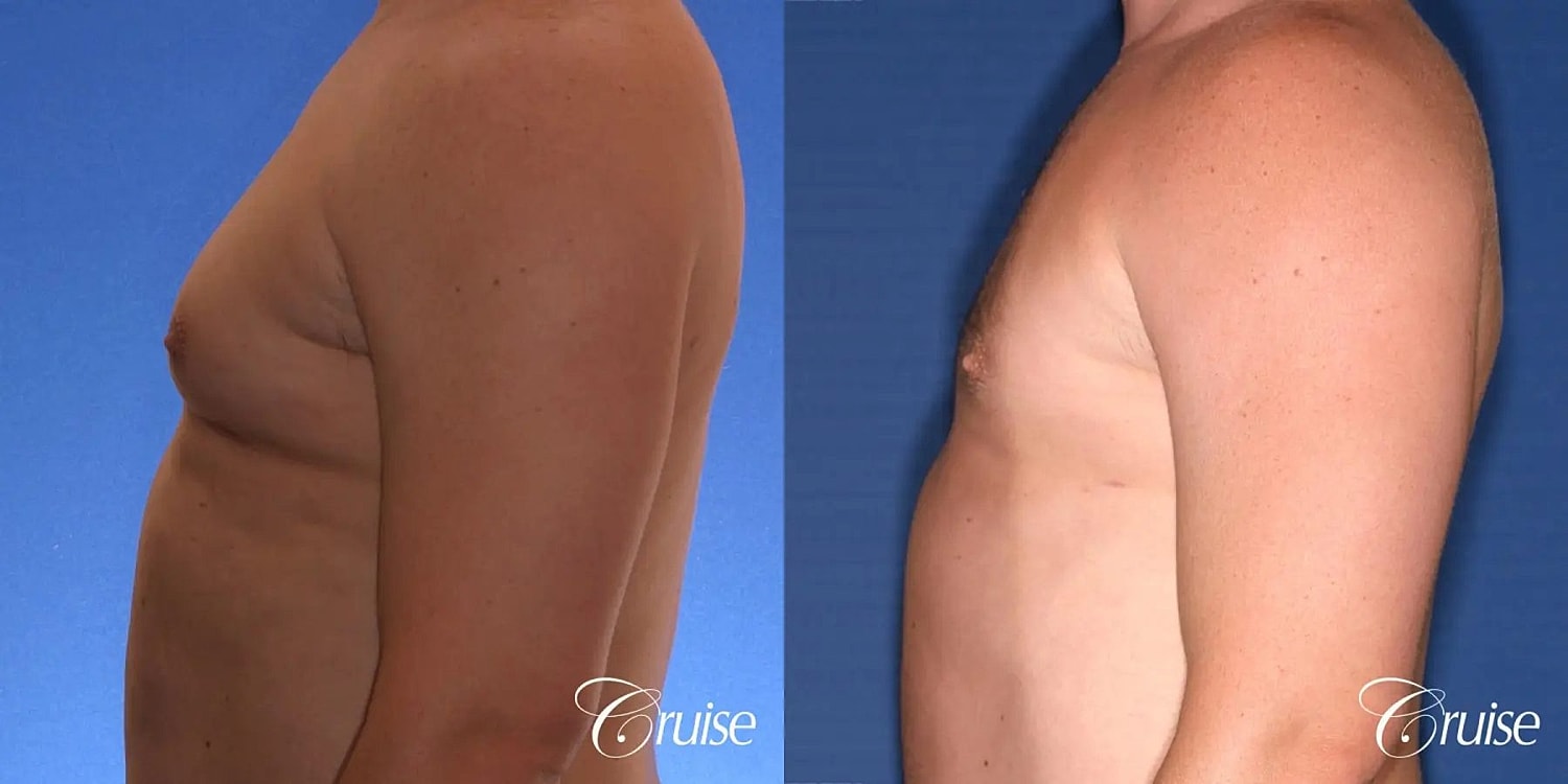 Gynecomastia Before & After