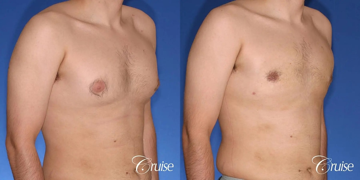 Gynecomastia Before & After