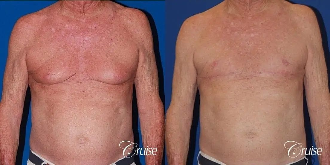 Gynecomastia Before & After
