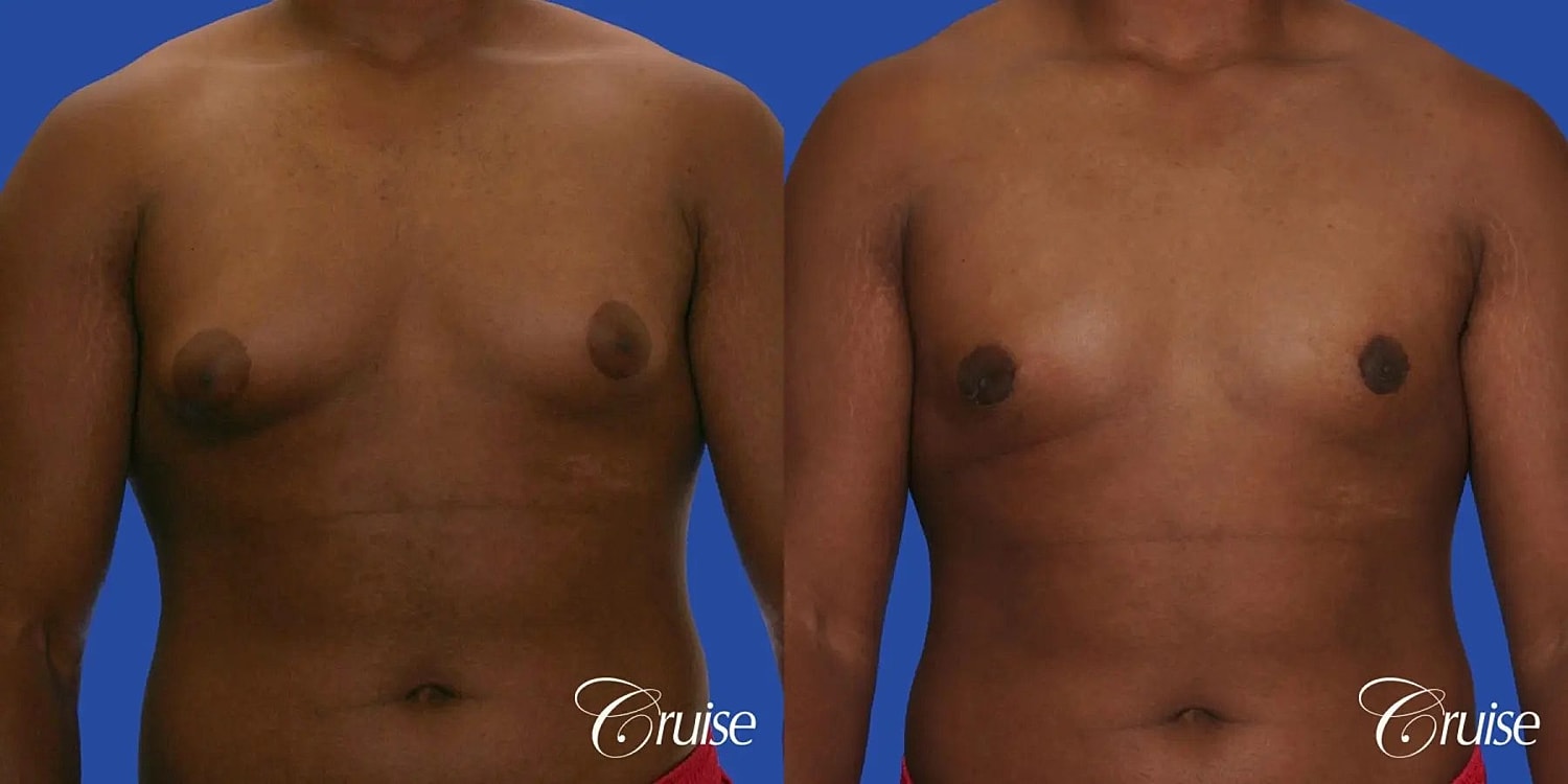 Gynecomastia Before & After