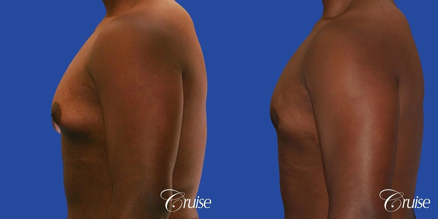 Gynecomastia Before & After